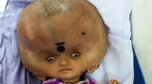 بالصور: هل هذا الطفل صاحب أكبر رأس في العالم؟