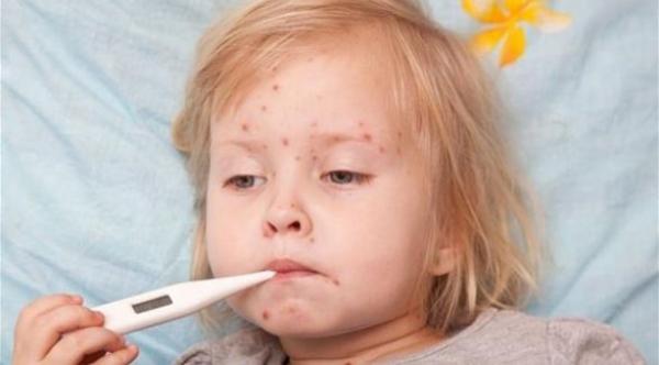الاشتباه في الجدري يستلزم استشارة الطبيب فوراً