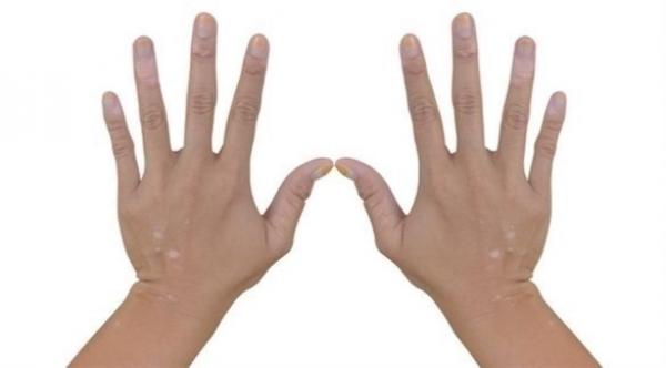 اليوم العالمي للجذام: 8 أعراض للمرض تهمك معرفتها