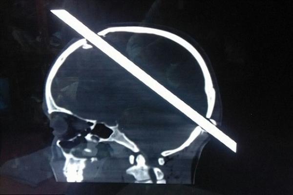 بالصور: لن تصدّق ما الذي اخترق جمجمة هذا الشاب