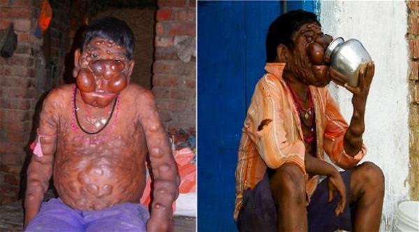 مئات الأورام تغطي وجه وجسد فتى هندي