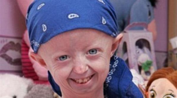  المراهقة العجوز هايلي أوكينيز التي كانت مصابة بمرض "شيخوخة الطفل المبكرة" (موقع دايلي ميل) 