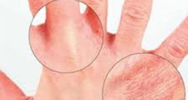 ظهور البقع الزرقاء في الجسم ناتج عن صدمة نفسية