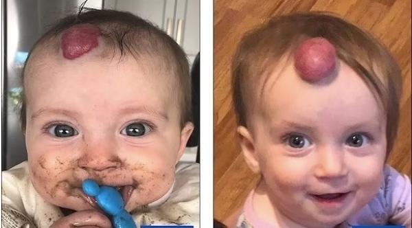 نجاة طفلة رضيعة بعد إصابتها بورم مكون من أوعية دموية