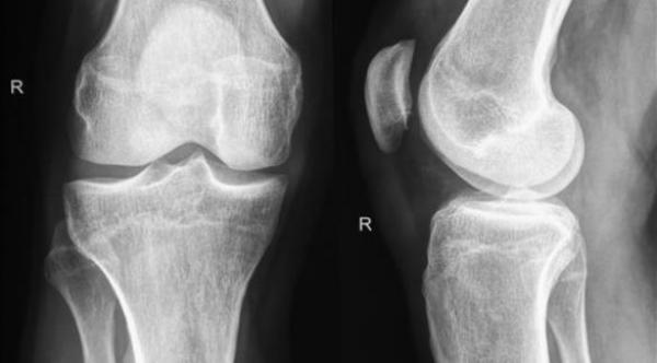 العلاج الهرموني يحسن صحة العظام بعد سن اليأس