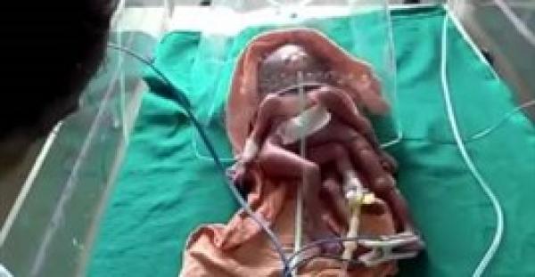 بالفيديو والصور.. لقطات صادمة لولادة طفلة بـ4 أذرع وأرجل