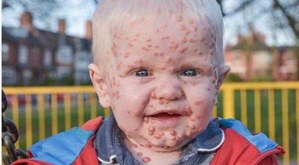 بريطانية تعرضت لصدمة نفسيه فأنجبت طفلاً مصابا بمرض نادر