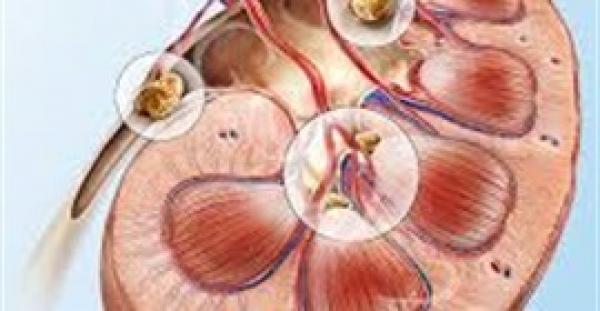 وصفة طبيعية تخلصك من حصوات والتهابات الكلى