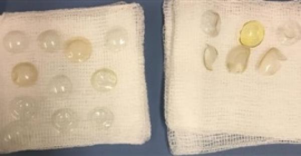 بالصور..جراحون يعثرون على 27 عدسة لاصقة في عين امرأة