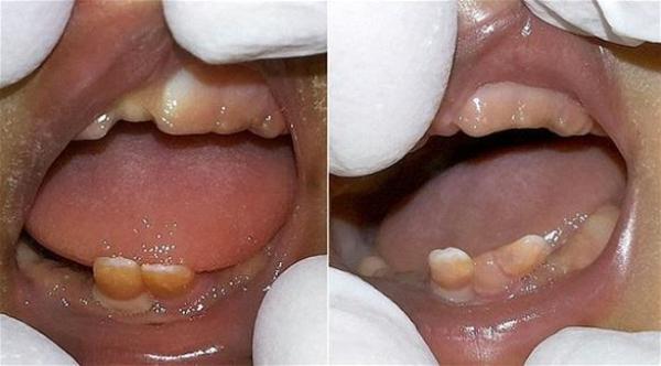 طفلتان توأم تولدان ولكل منهما سنان في الفم