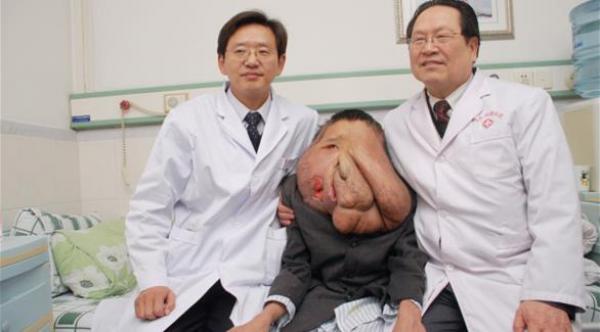 صيني يعييش مع ورم في وجهه وزنه 25 كيلوغراماً