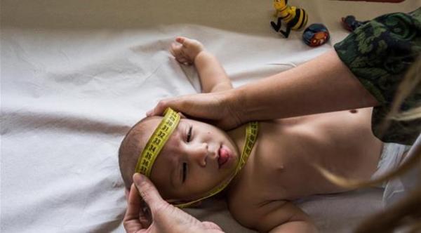 لماذا يربط العلماء بين "زيكا" وضمور أدمغة حديثي الولادة؟