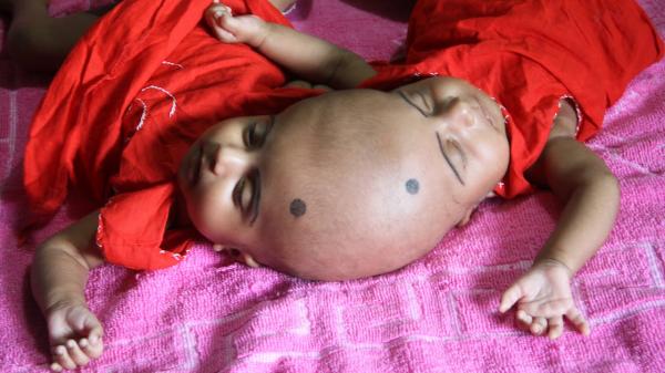 بالفيديو: طفلتان ملتصقتان بانتظار عملية جراحية لفصلهما