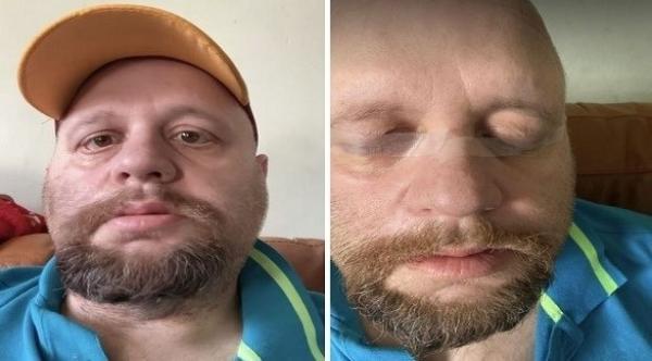 حالة نادرة تضطر شخصا لإغلاق عينيه بشريط لاصق