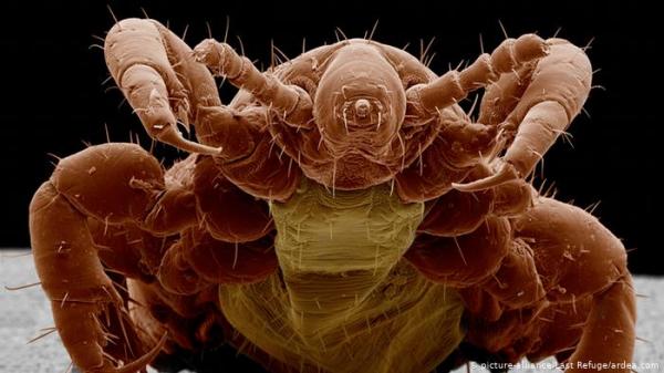 وفاة طفلة أمريكية نتيجة مضاعفات إصابتها بالقمل