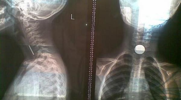  فريق طبي ينهي معاناة طفلة علقت بحنجرتها عملة معدنية ‎ 