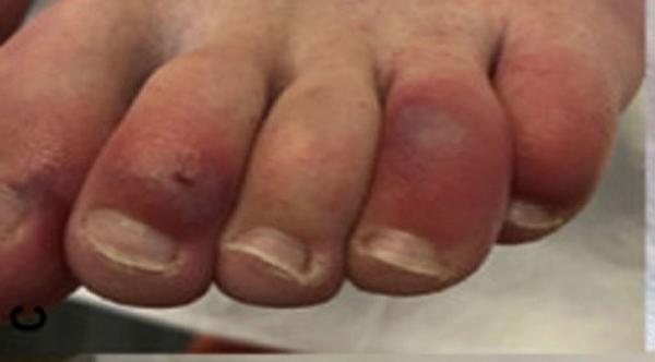 أعراض جديدة للفيروس التاجي ..تغير لون أصابع القدمين