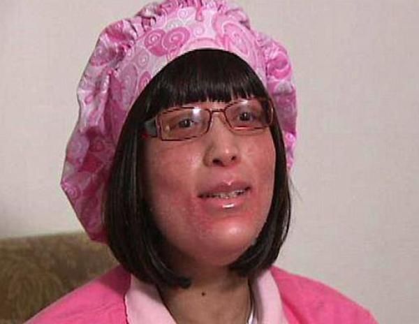 حالة غريبة لشابة ينمو على جسدها أظافر بدلا من الشعر