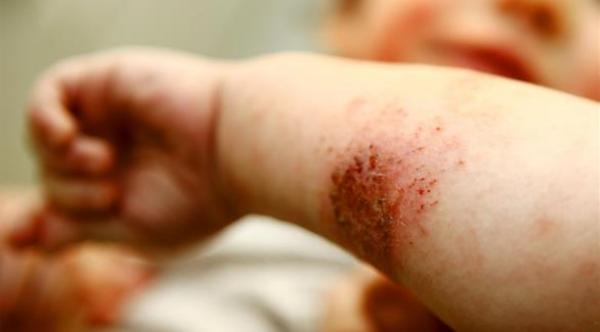 التغيرات الجلدية قد تشير إلى سرطان الجلد لدى الأطفال