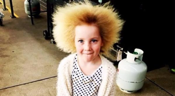 حالة نادرة تجعل شعر هذه الطفلة منتصباً دائماً