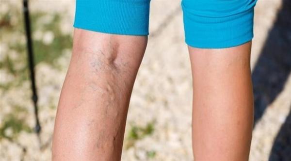 ما هي أسباب ظهور دوالي الساقين؟