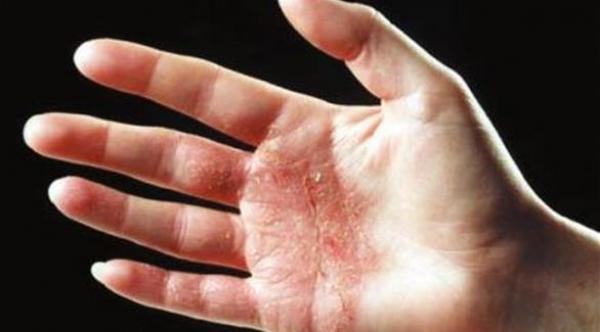 مؤشرات أولية على الإكزيما التلامسية