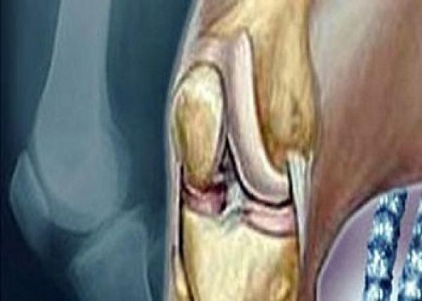 عقار من النباتات الطبيعية لعلاج آلام المفاصل