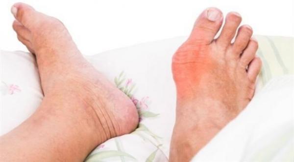 أغذية ينصح بعدم تناولها من طرف مرضى بالنقرس