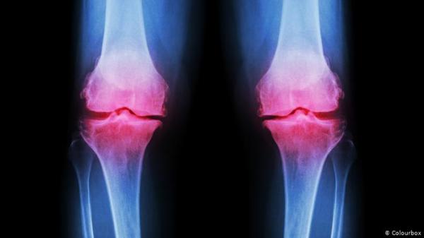 حتى عند كسر عظمها لم تشعر بألم.. امرأة تبهر العالم