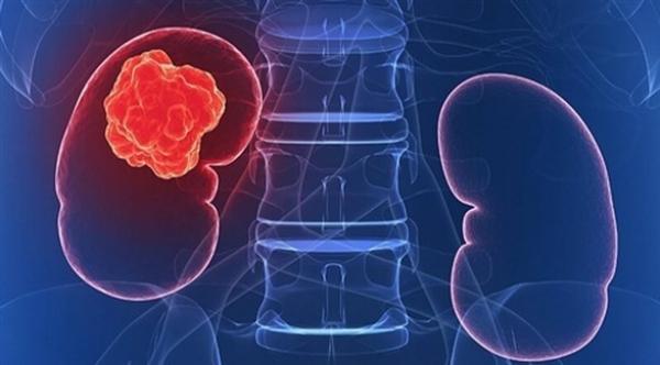 سرطان الكلى : أسبابه وعوامله