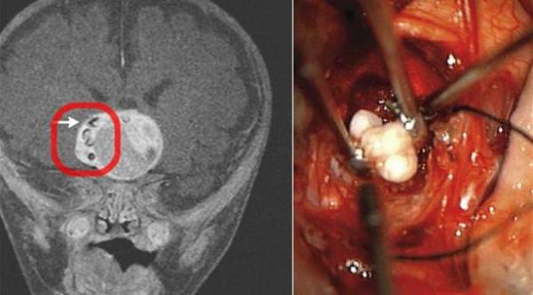 العثور على"سن بشري" ينمو في دماغ رضيع