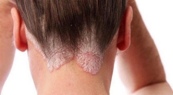 هل يحتاج مرضى الصدفية إلى علاج نفسي؟