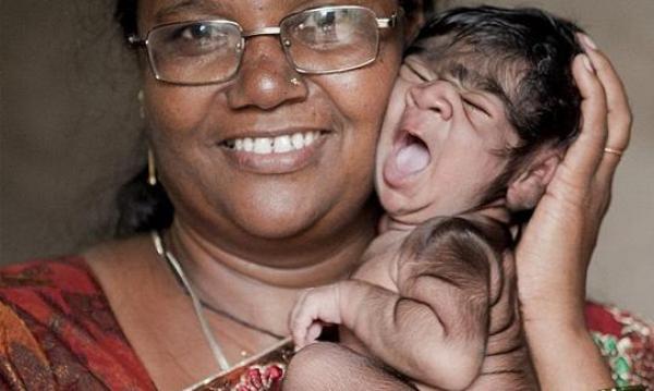 ولادة طفلة هندية "مستذئبة" مغطاة بالشعر