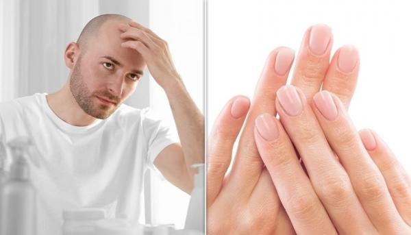 هل هناك علاقة بين الإصابة بالصلع و طول الأصابع؟