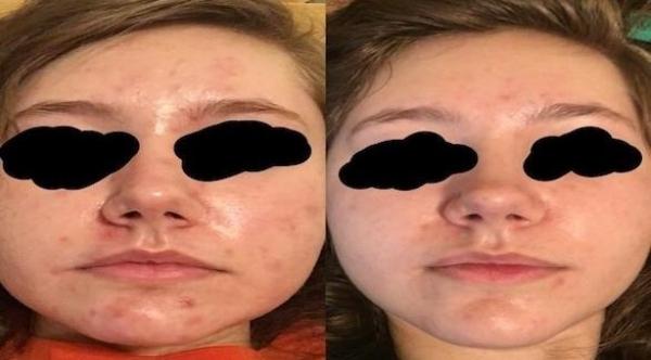 شابة تنجح في التخلص من حب الشباب بزيت الورد فقط