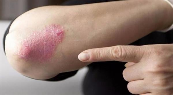 الصدفية.. أسبابها وأعراضها وطرق علاجها