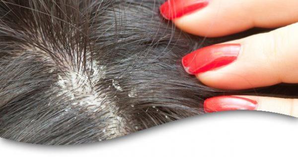 وصفة للقضاء على القشرة