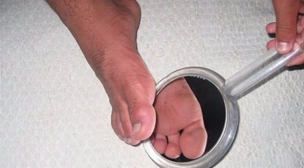 لمريض السكري .. افحص قدميك كل ليلة