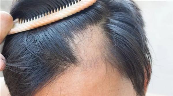 فيروس جديد يسبب تساقط الشعر المفاجئ لـ 155 شخصًا في بلد آسيوي