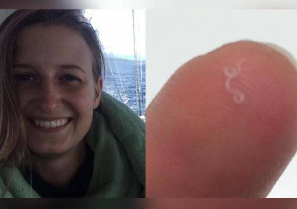 بالفيديو: استخراج 14 دودة من عيني امرأة