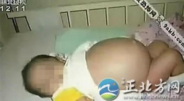 رضيع يلد شقيقه التوأم من بطنه بعملية قيصرية