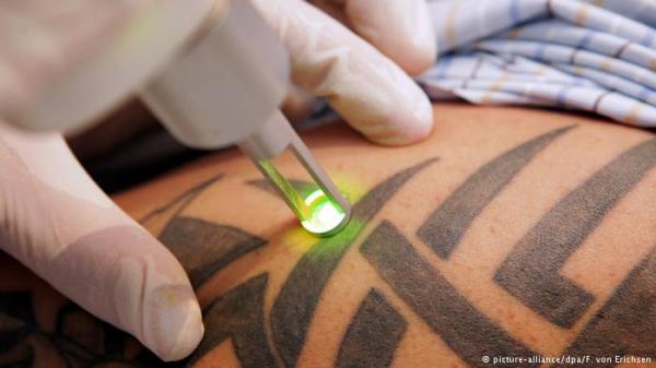 بالفيديو : الوشم وطرق إزالته