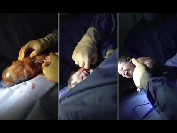 بالفيديو: لحظة خروج جنين من كيسه الأمنيوسي