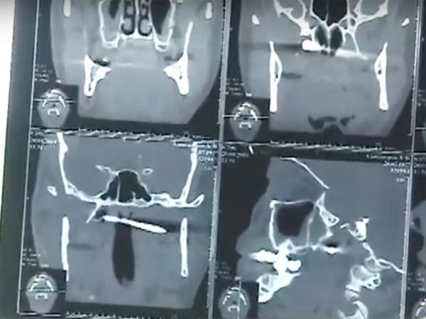 بالفيديو.. يكتشف أنه عاش مع مسمار في رأسه دون علمه