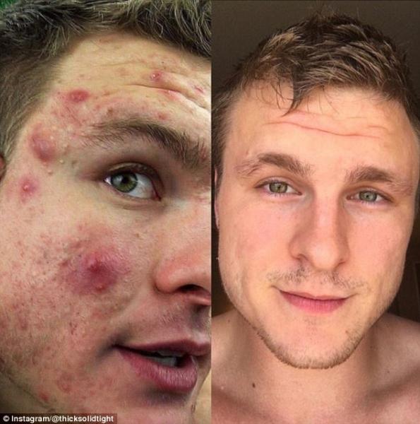 بالفيديو.. شاب يكشف سر تخلصه من حب الشباب