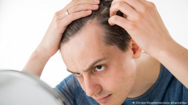 فطريات الرأس تهدد بفقدان الشعر! هكذا يمكنك التخلص منها!