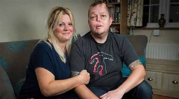 زراعة أنف في جبهة بريطاني لتعويض آخر فقده بالسرطان