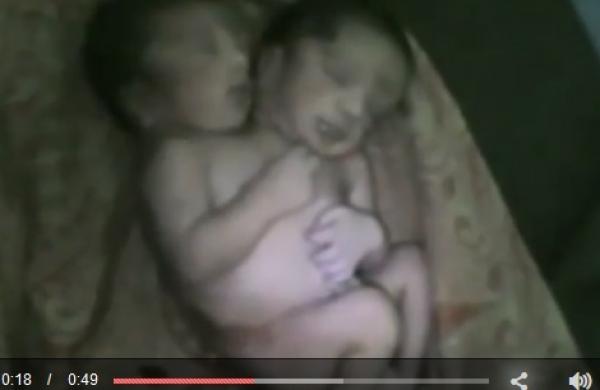 بالفيديو: امرأة تنجب طفلاً برأسين في الهند