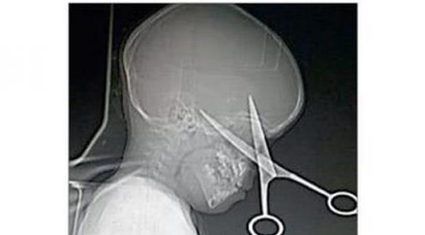 نجاة طفل بأعجوبة من مقص اخترق جمجمته