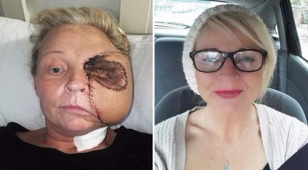 تخسر نصف وجهها بعدما ضربت رأسها بالفرن